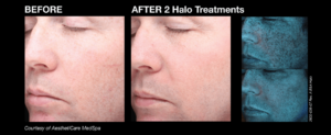 halo_before_and_afters_7_new