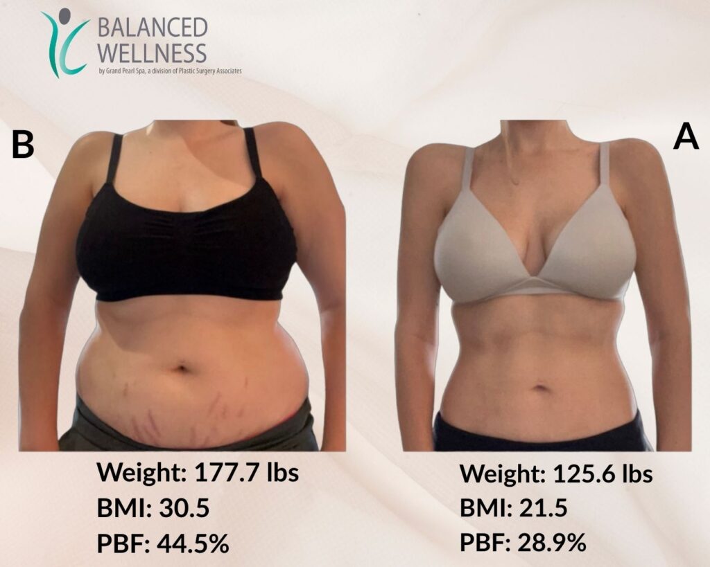 before and after weight loss patient