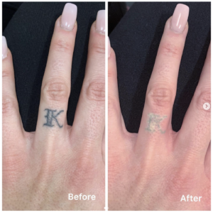 laser tattoo removal with picosure