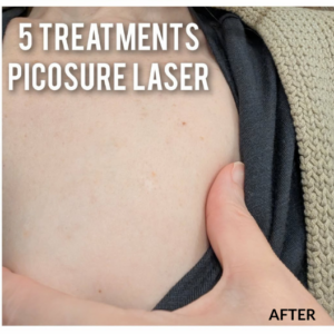 photo of a body part with no tattoo after laser treatment